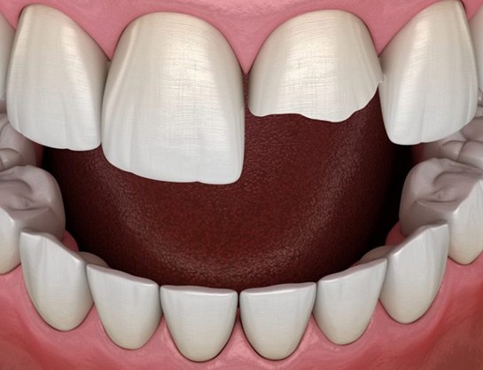 Model of chipped upper tooth