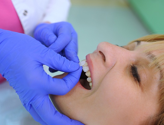 Dentist preparing to place veneers on patient’s teeth